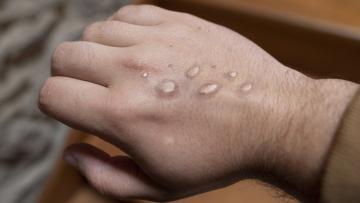 Mpox: Detetados dois novos casos em Portugal