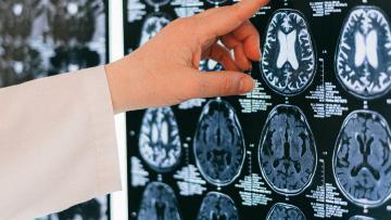 Descoberta primeira transmissão acidental da doença de Alzheimer