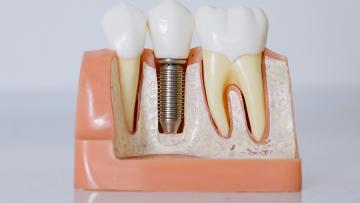 Seis milhões de pessoas têm falta de dentes em Portugal