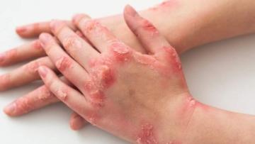 Novo medicamento ativado pela luz reduz os efeitos da psoríase